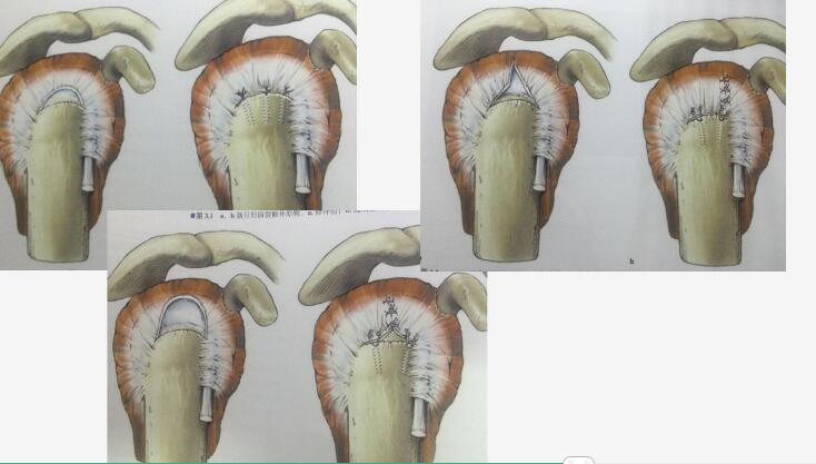 肩袖损伤分型诊断以及缝合方法