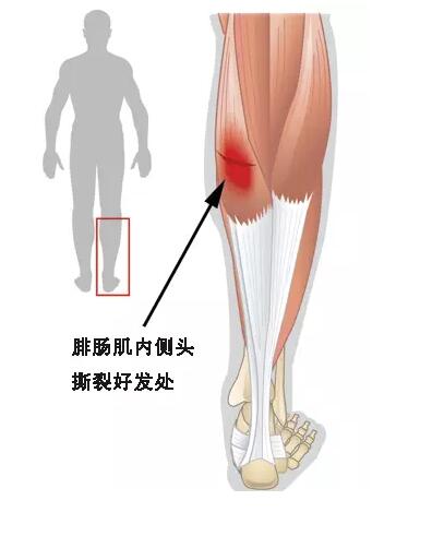 腓肠肌群的损伤,治疗与预防 - 好医术早读文章 - 好医术-赋能医生守护