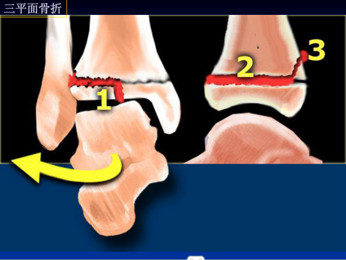 踝關節骨折不那麼明顯的骨折