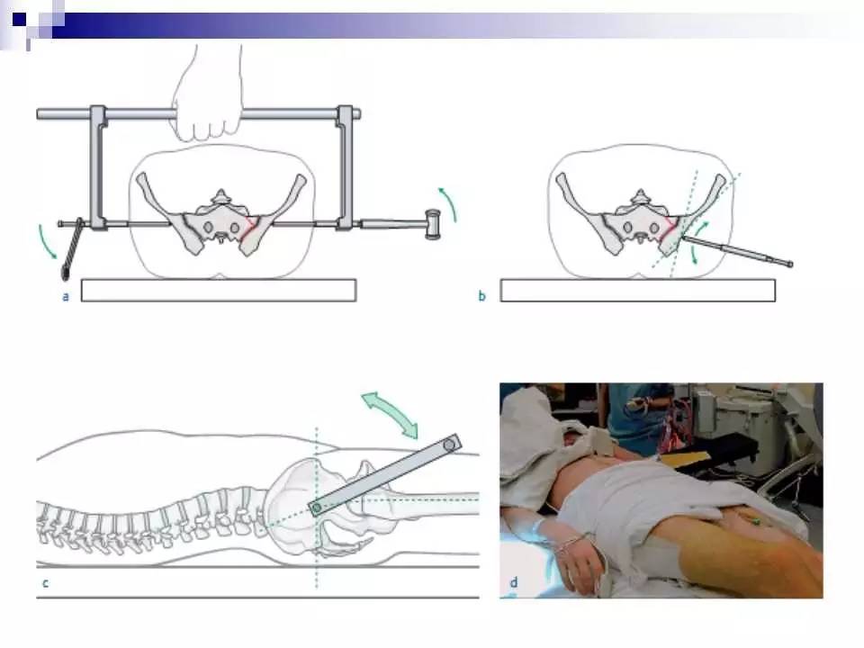 骨盆骨折的分类及治疗