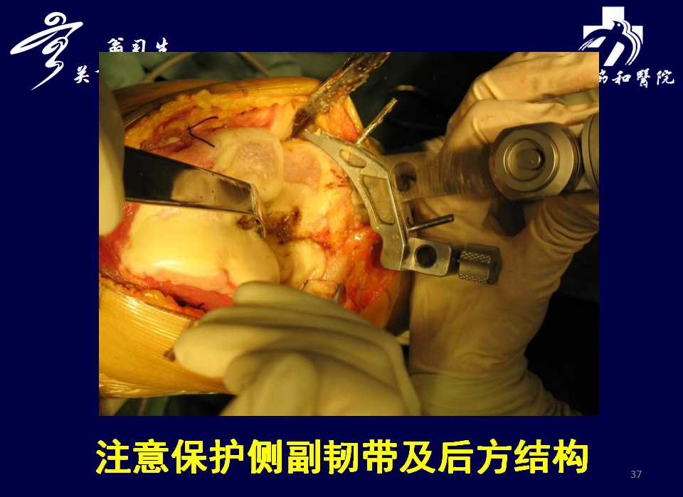 全膝关节置换术怎么截骨?