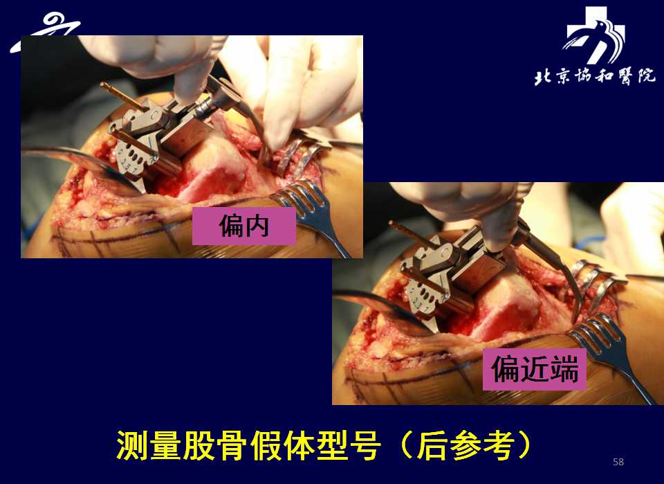 全膝關節置換術怎麼截骨?