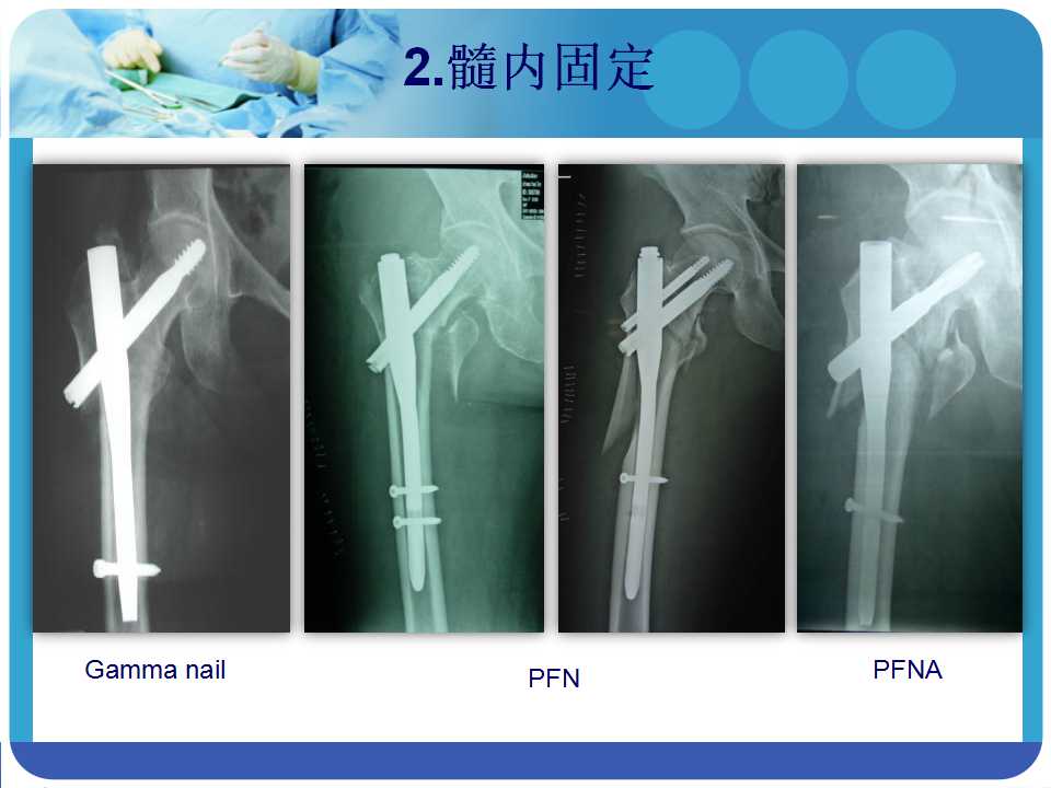 最常用的pfna髓内钉你真的了解吗