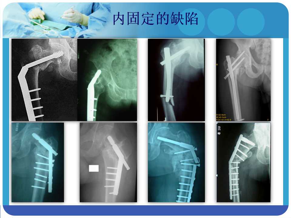 最常用的pfna髓内钉你真的了解吗