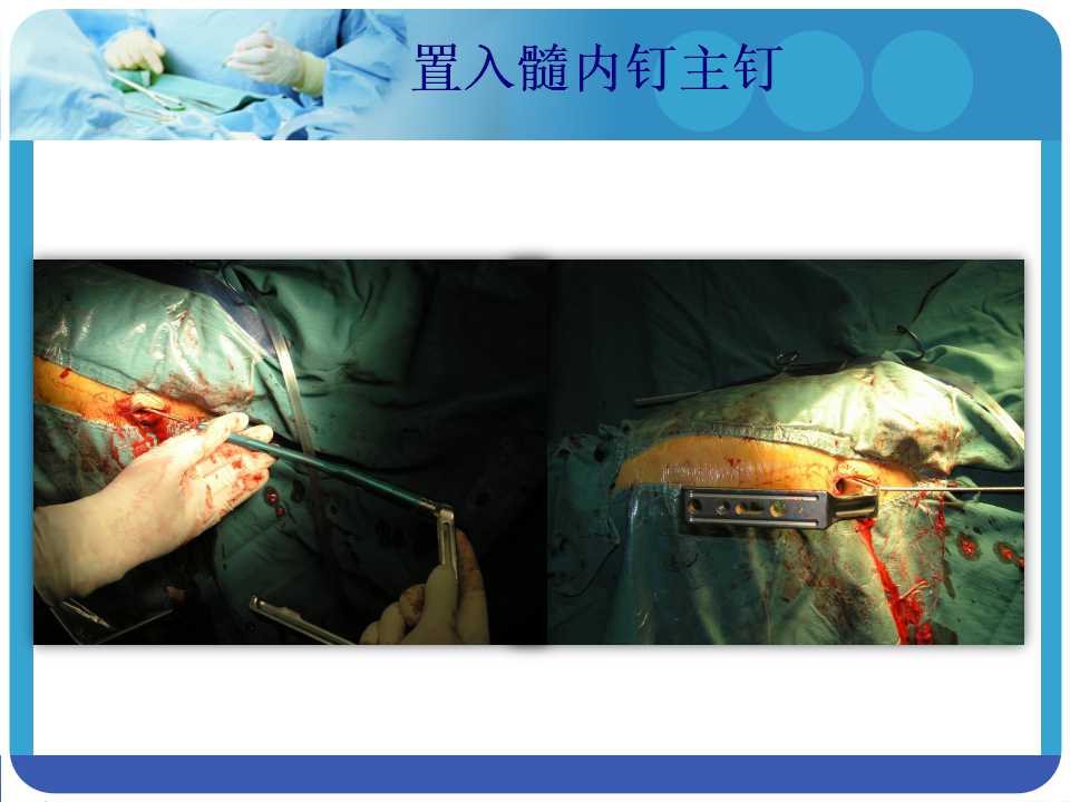 最常用的pfna髓内钉你真的了解吗