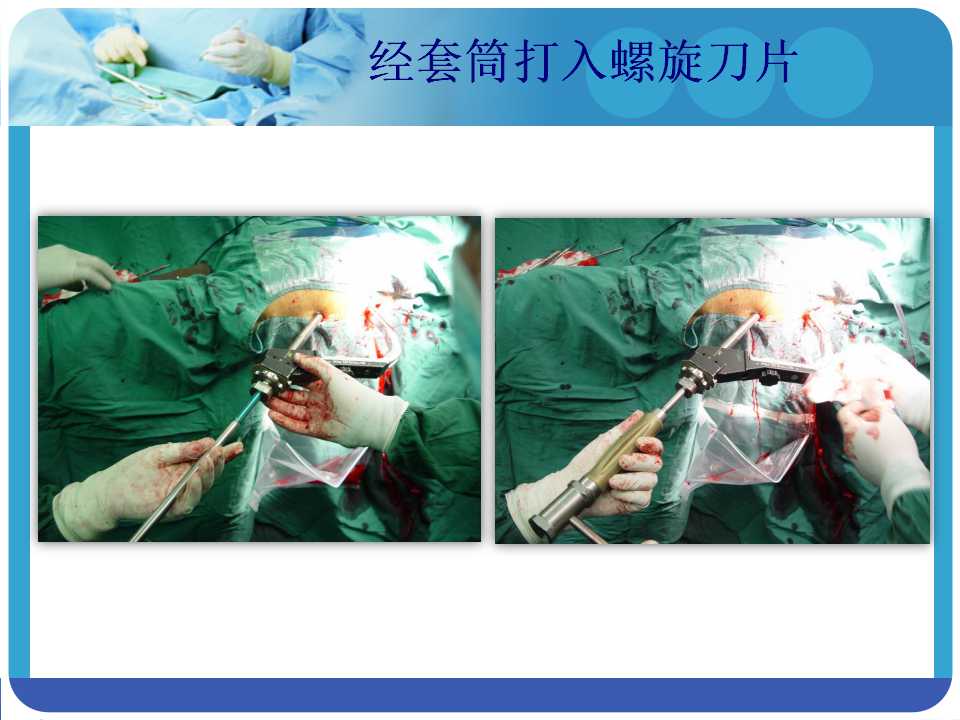 最常用的pfna髓内钉你真的了解吗