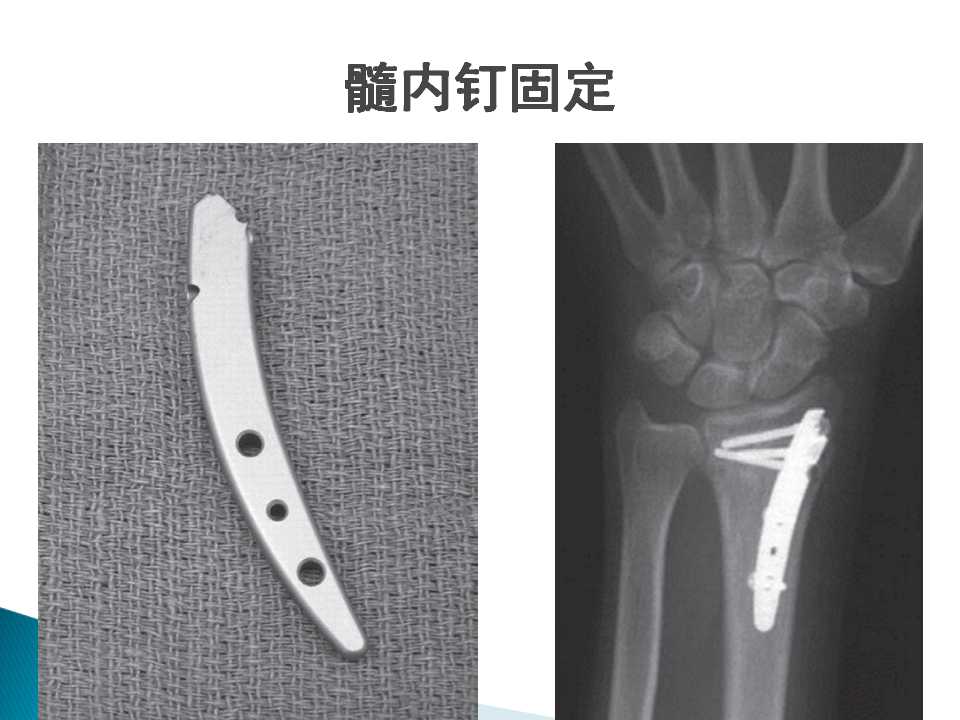 桡骨远端骨折的分类及治疗技巧