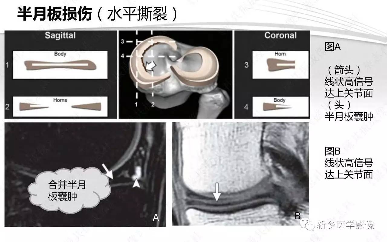 半月板損傷手術前後的mri診斷