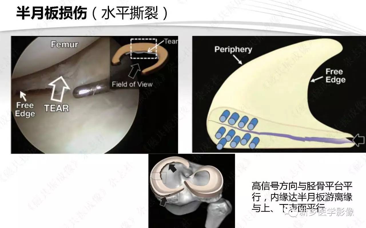 半月板損傷手術前後的mri診斷