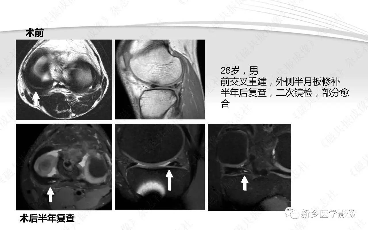 眼结膜囊肿手术前后对照 - 知乎