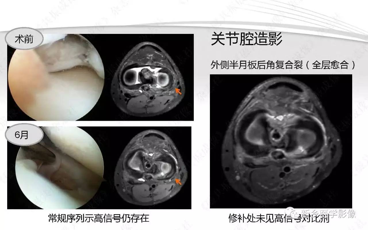 半月板損傷手術前後的mri診斷