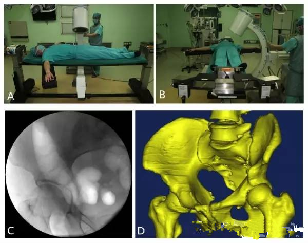 骨盆,髖臼微創手術中透視影像怎麼做