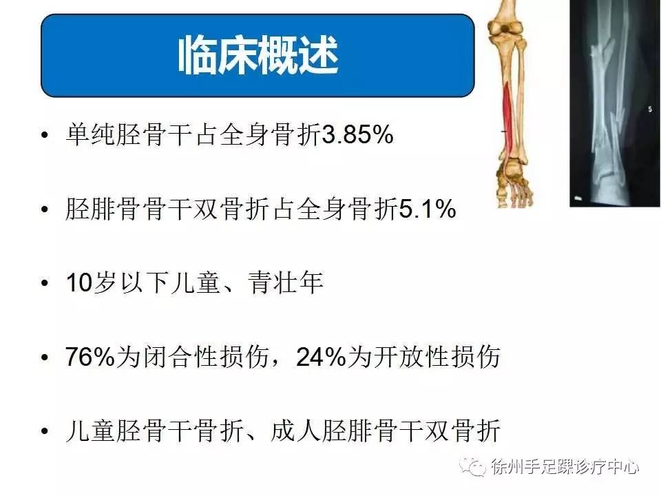胫骨干骨折的诊断及治疗要点 好医术早读文章 好医术 赋能医生守护生命