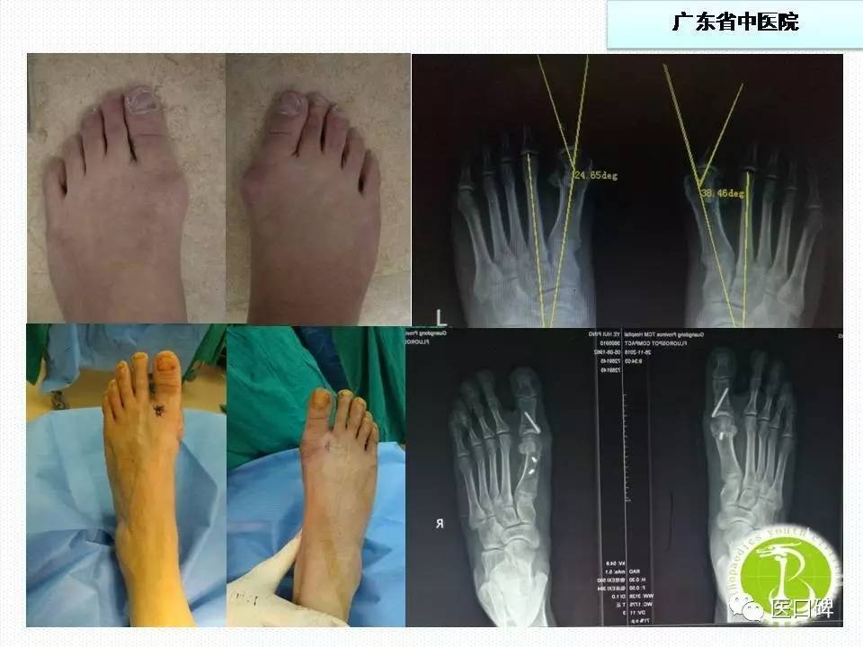 拇外翻畸形矫正有哪些手术方式？ 1582