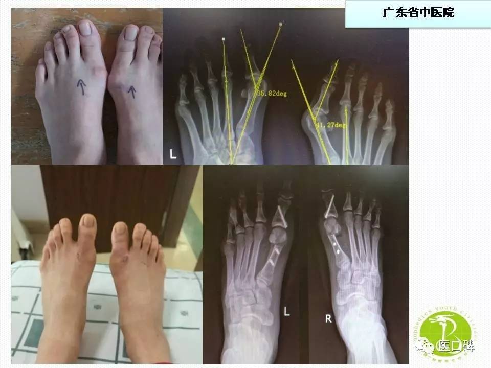 拇外翻畸形矫正有哪些手术方式？