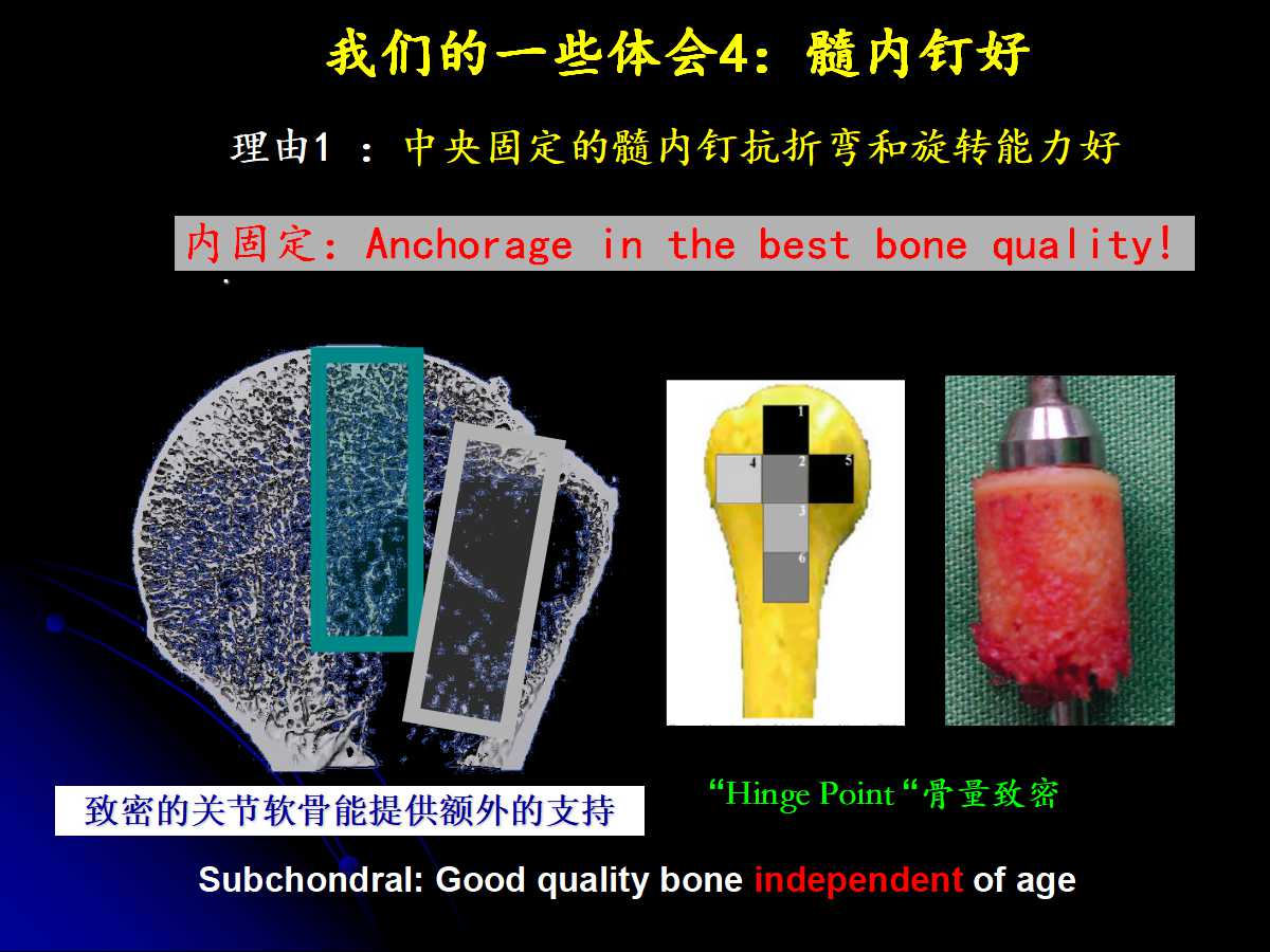 一篇课件读懂髓内钉治疗肱骨近端骨折