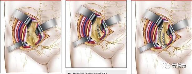 髂骨翼骨折入路图片