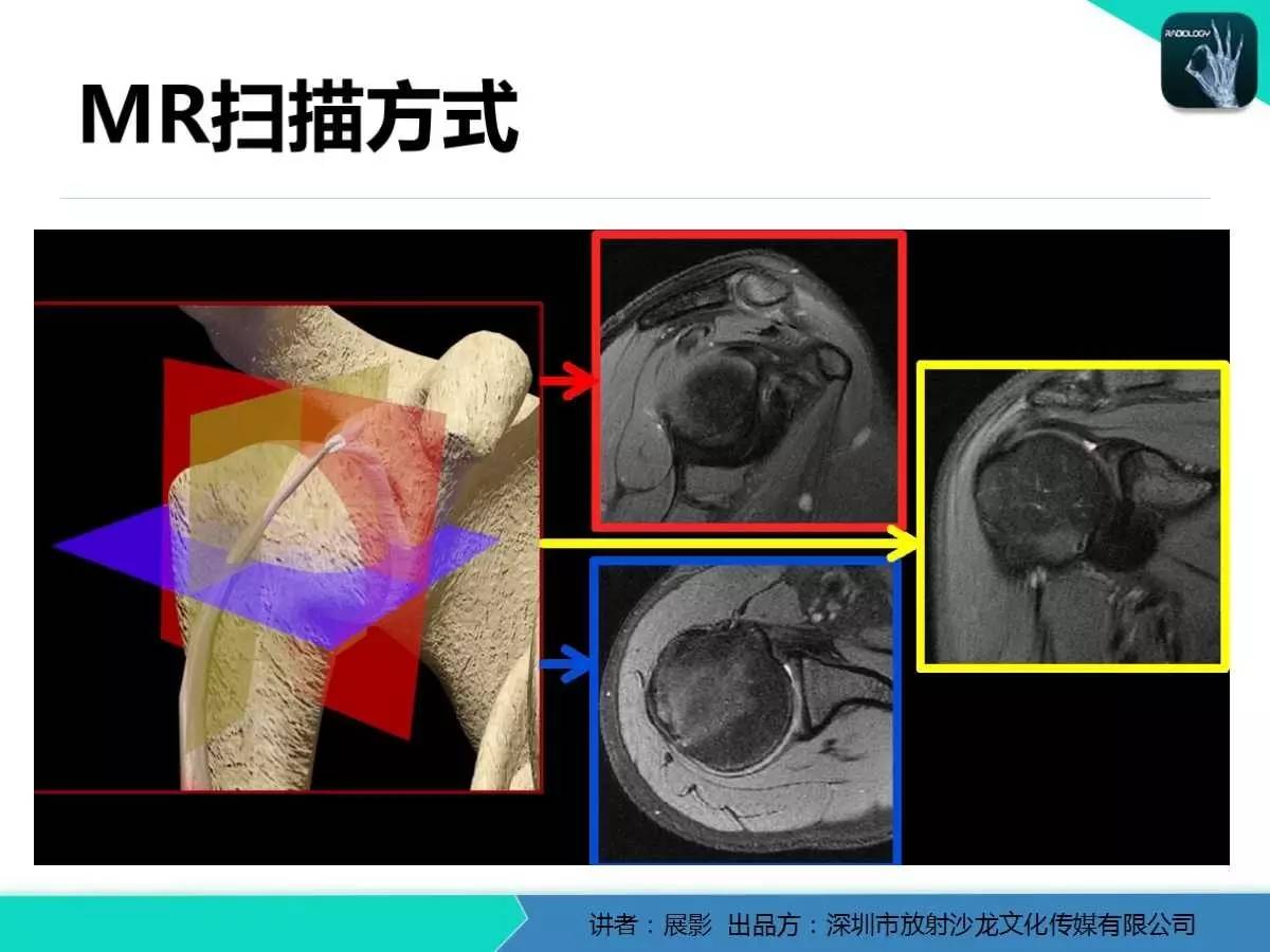 肩峰下撞擊綜合徵和肩袖損傷的mr表現