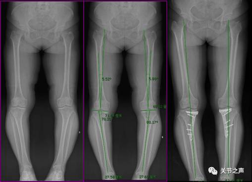10°内翻畸形,膝关节轻度肿胀,双膝关节前内侧固定压痛点,膝关节rom