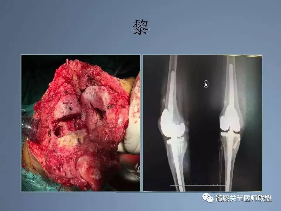 全膝关节置换术的手术流程和要点