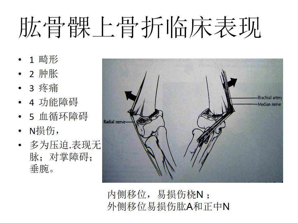 小兒肱骨髁上骨折的復位及治療技巧