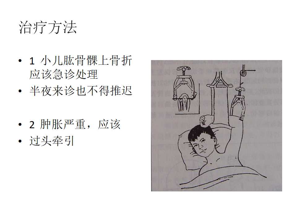 小儿肱骨髁上骨折的复位及治疗技巧