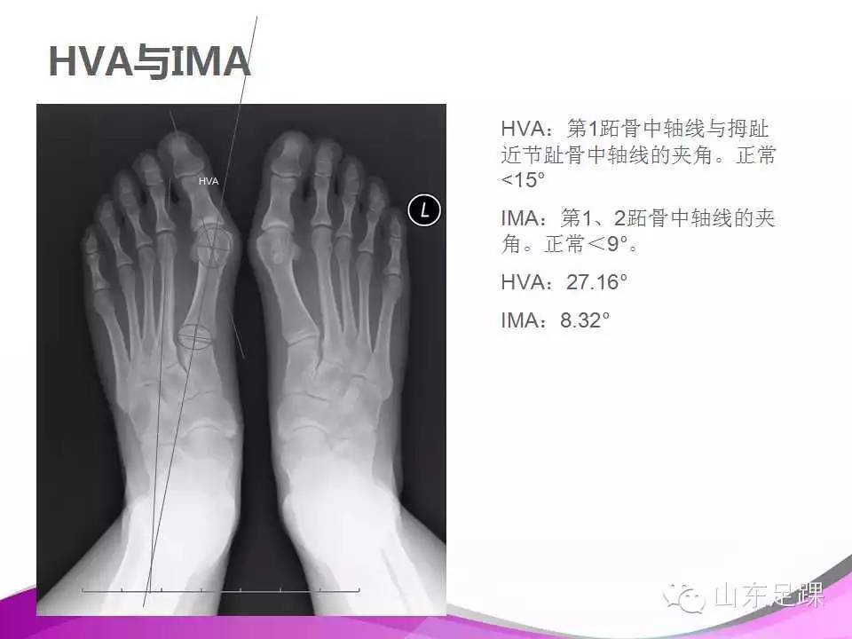 拇外翻x线测量评估及术式选择