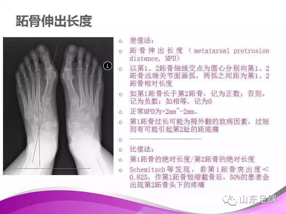 拇外翻x线测量评估及术式选择