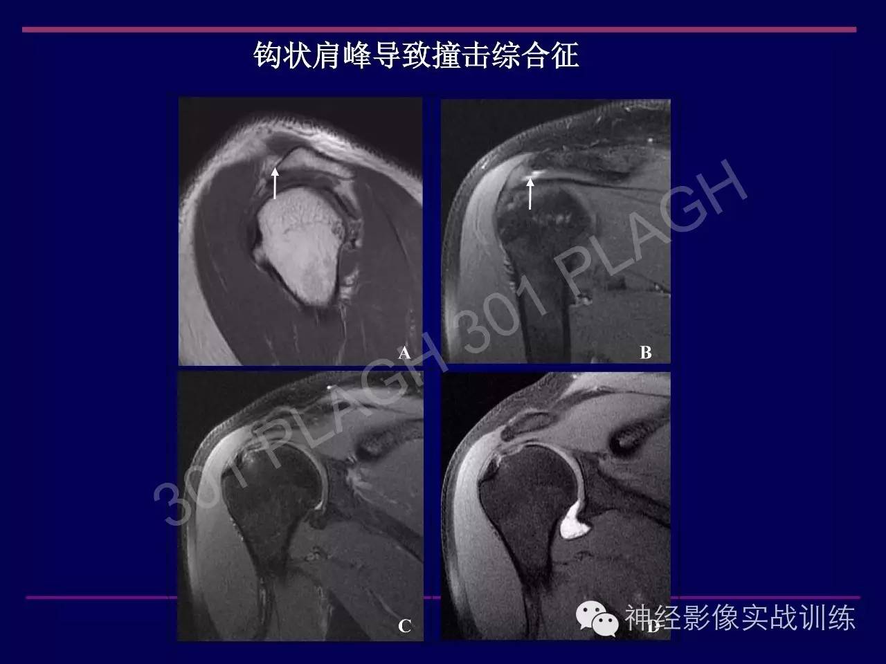 肩关节撞击综合征的MR诊断