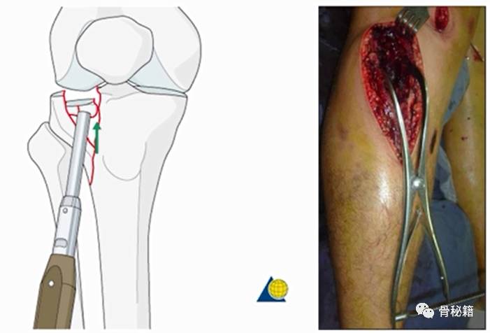 脛骨平臺骨折的復位技巧解析