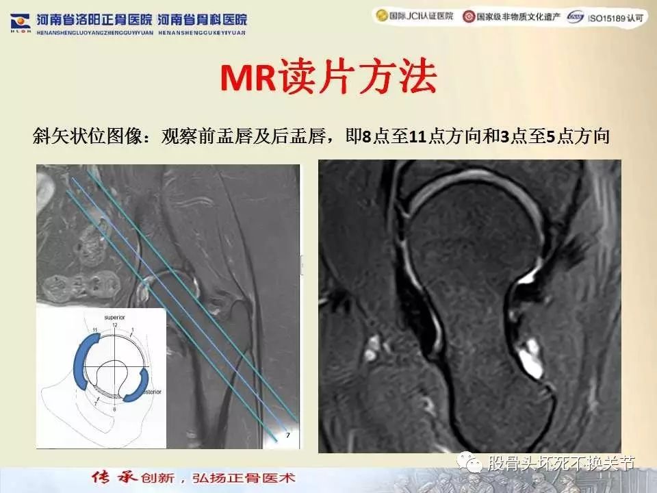 髖臼盂唇損傷的mri診斷