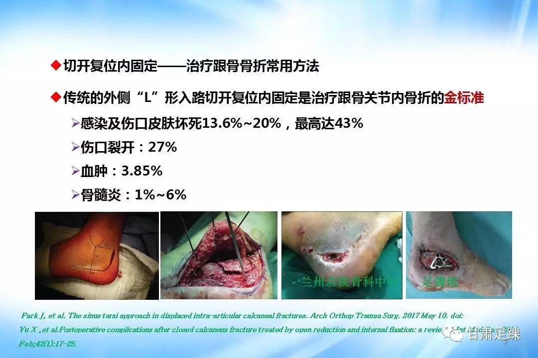 其中經跗骨竇入路微創治療跟骨關節內骨折能有效避免術後傷口感染