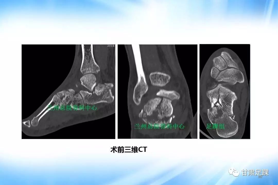 經跗骨竇切口治療跟骨骨折的新術式