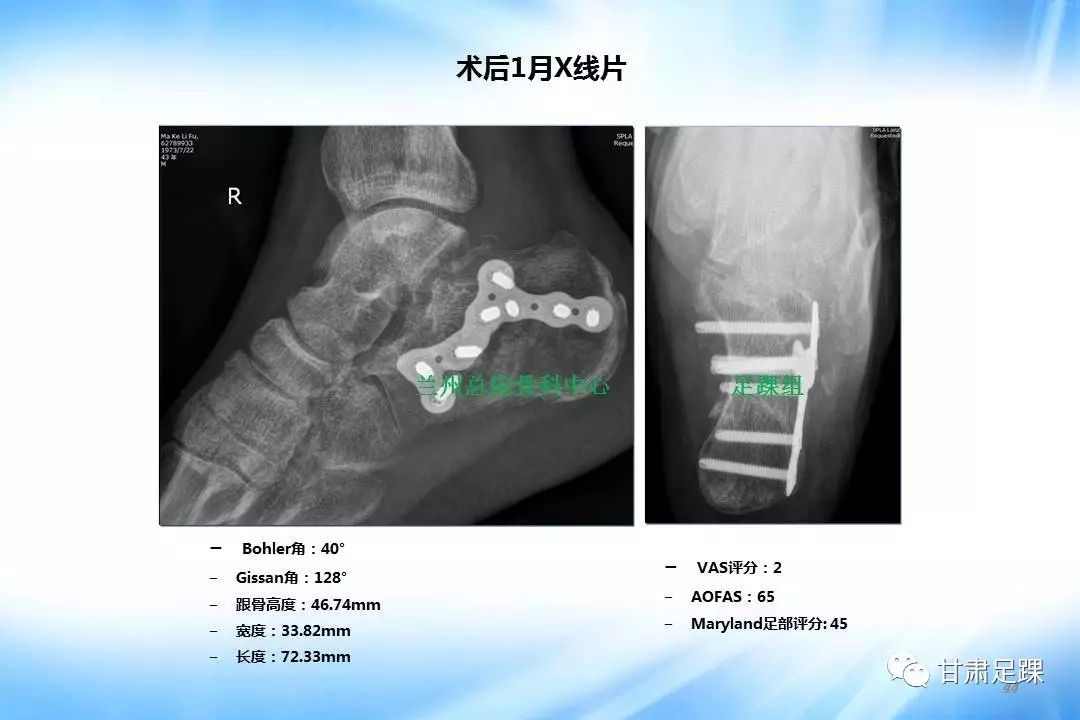 近年來微創技術在足踝外科得到了快速發展,其中經跗骨竇入路微創治療