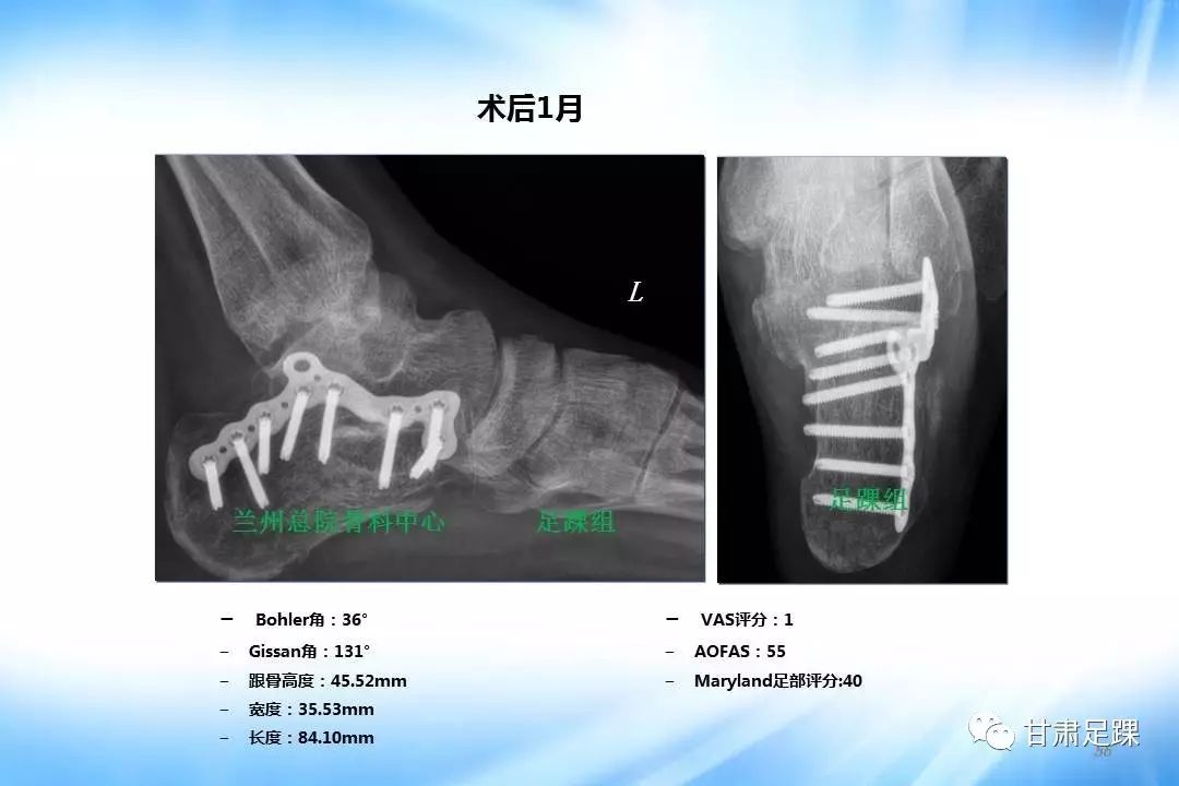 經跗骨竇切口治療跟骨骨折的新術式