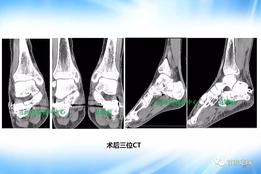 經跗骨竇切口治療跟骨骨折的新術式