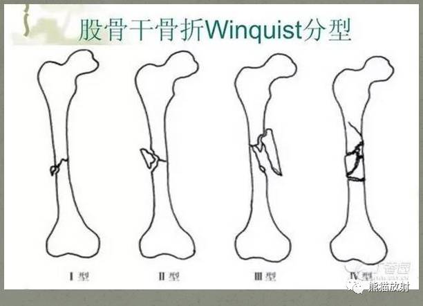 下肢骨折分型大全(内含示意图)