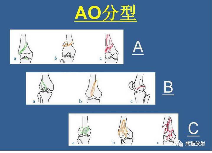 下肢骨折分型大全（内含示意图） - 好医术早读文章 - 好医术-赋能医生守护生命