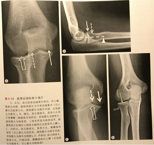 肱骨遠端骨折的臨床診治要點