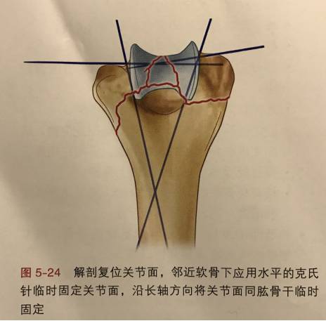 肱骨遠端骨折的臨床診治要點