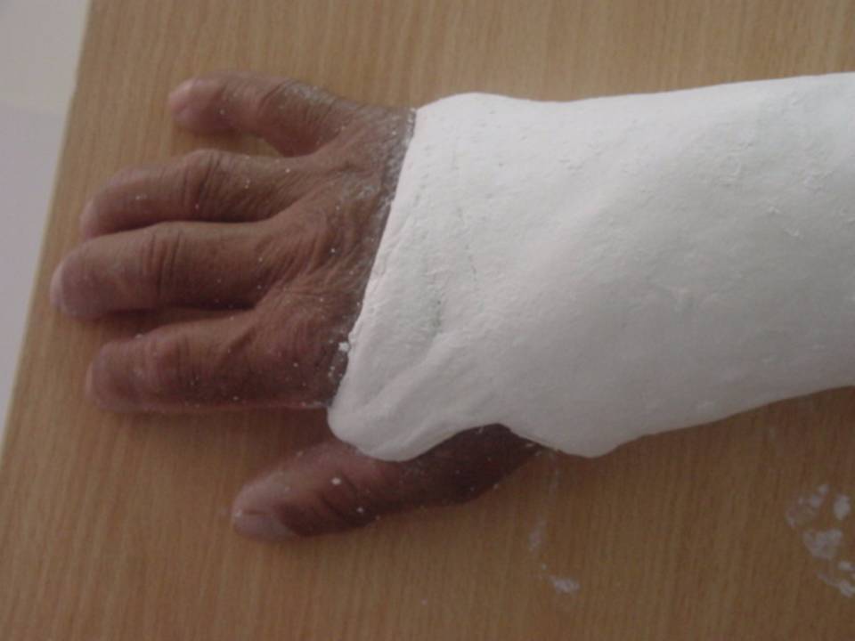 推荐| 四肢骨折后石膏外固定详解 - 好医术早读文章 - 好医术-赋能