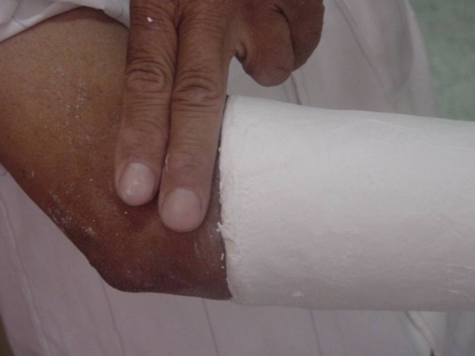 推荐| 四肢骨折后石膏外固定详解 - 好医术早读文章 - 好医术-赋能