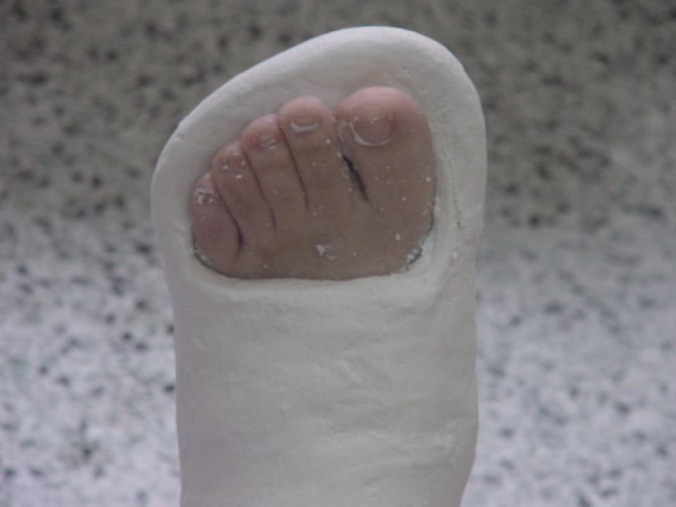 推荐| 四肢骨折后石膏外固定详解 - 好医术早读文章 - 好医术-赋能