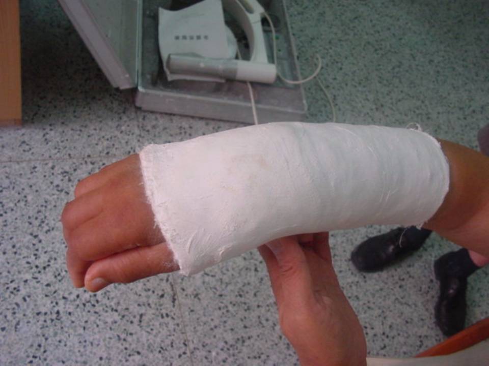 推荐| 四肢骨折后石膏外固定详解 - 好医术早读文章 - 好医术-赋能