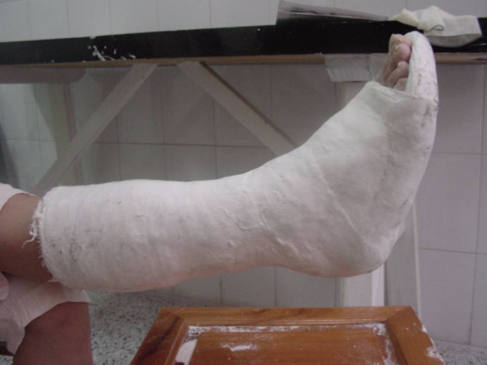 推荐| 四肢骨折后石膏外固定详解 - 好医术早读文章 - 好医术-赋能