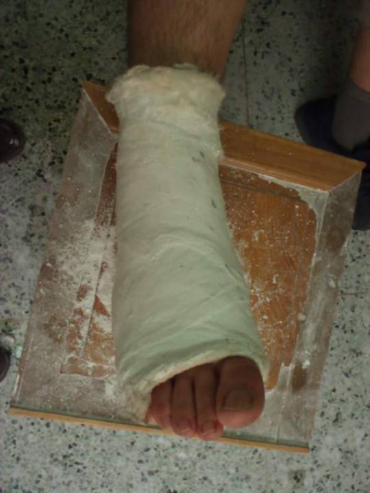 推荐| 四肢骨折后石膏外固定详解 - 好医术早读文章 - 好医术-赋能