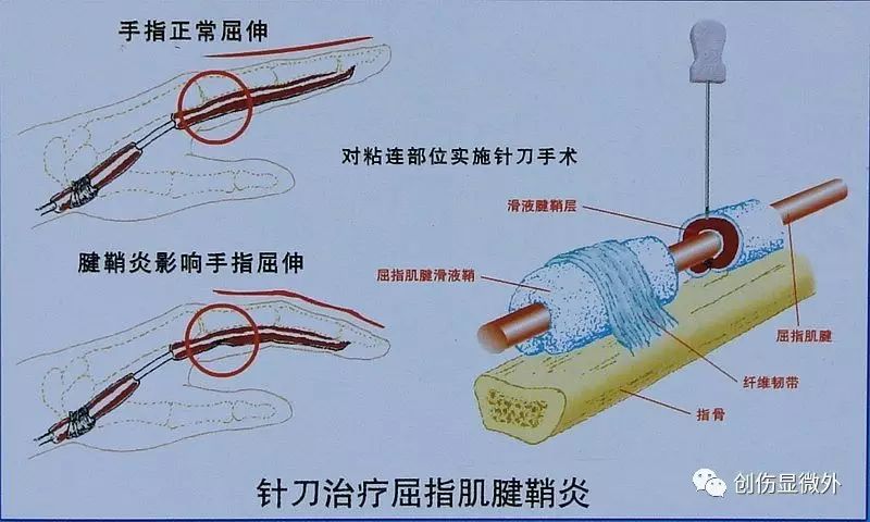 狹窄性腱鞘炎如何進行治療?