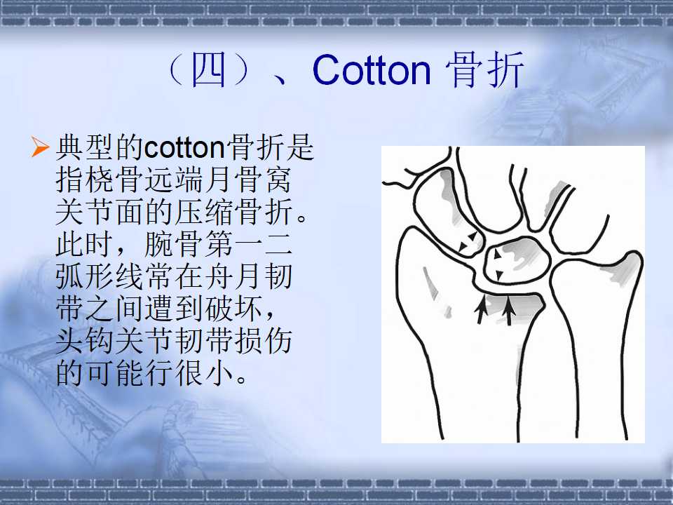 Colles 骨折的分型及治疗策略 - 好医术早读文章 - 好医术-赋能医生守护生命