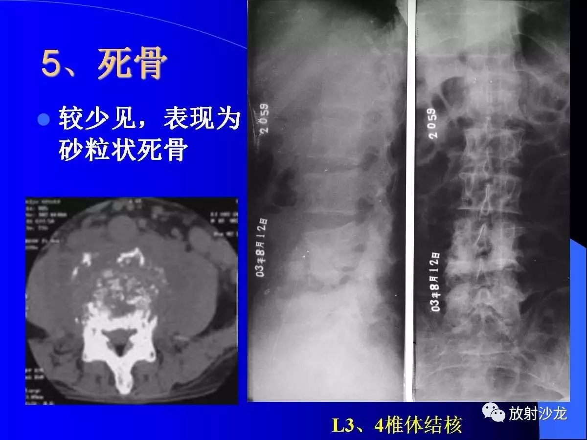 前沿医学-中国筋膜技术脊柱侧弯矫正技术介绍及临床案例影像学及体态分析 - 知乎