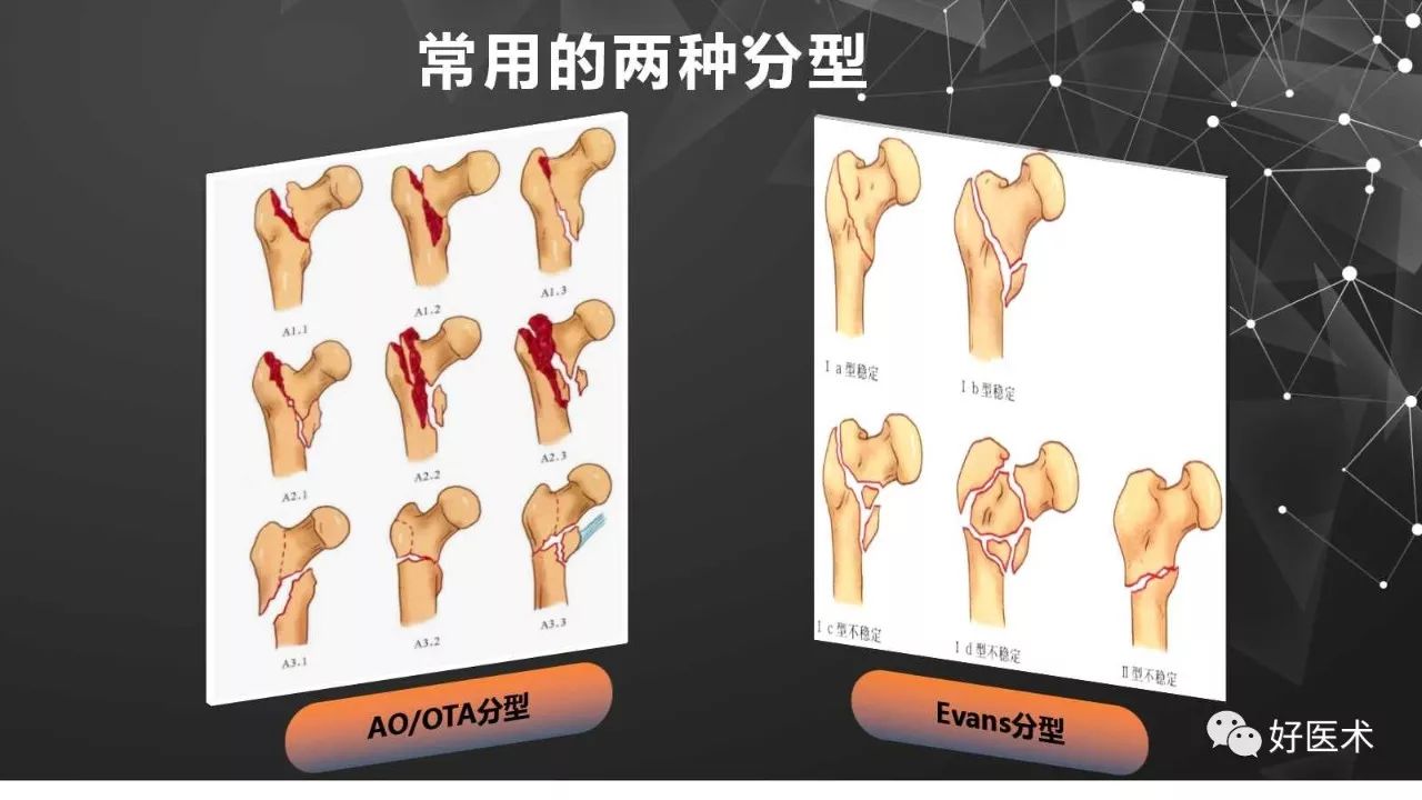 intertan在股骨粗隆間骨折的應用及技術要點